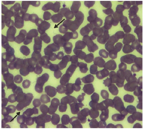 The figure shows a stained thin smear of peripheral blood from a newborn child (born in Colorado in 2011) and indicates the presence of numerous spirochetes, consistent with infection with tickborne relapsing fever.